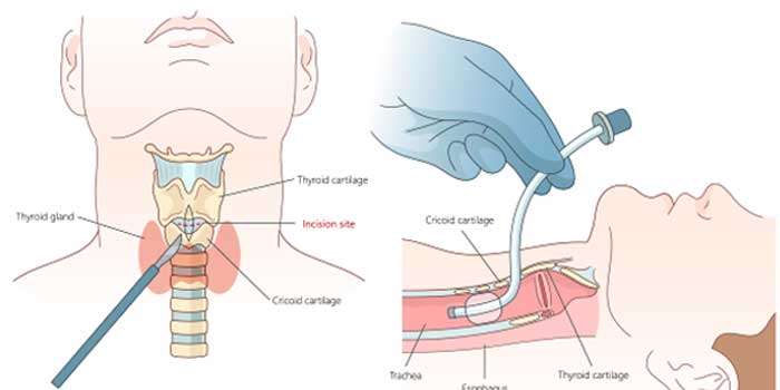 Burtron Cricothyrotomy Kit