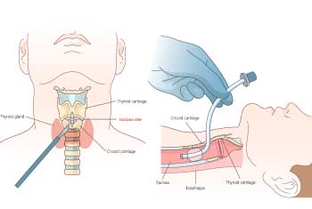 Burtron Cricothyrotomy Kit